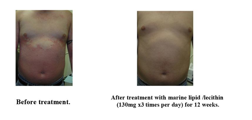 Patient with placque type psoriasis