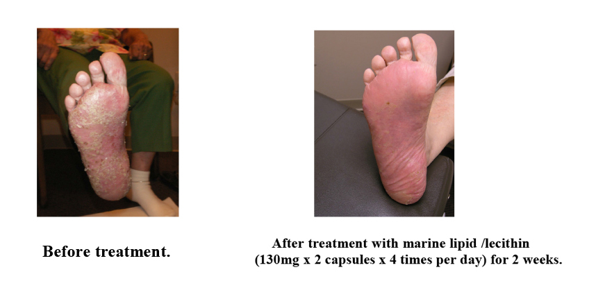 Patient with severe pustular psoriasis.