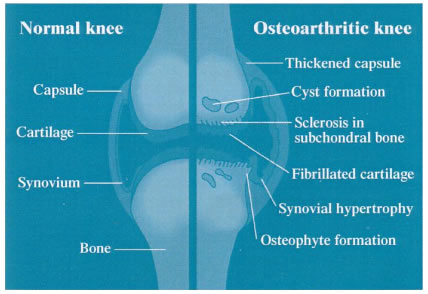 圖1. 正常的和關節炎關節的結構