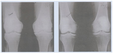 圖6. 一個53歲III度骨關節炎患者站立的X射線圖片