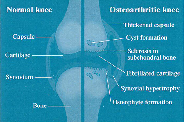 健康な膝と変形性関節炎の膝の構造
