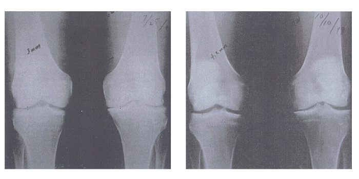 grade III osteoarthritis treating with GLME